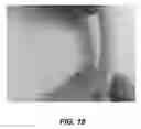 Fig. 18 - Bidirectional stent and method of use thereof