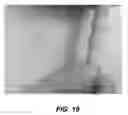 Fig. 19 - Bidirectional stent and method of use thereof