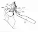 Fig. 01 - Implant delivery devices, systems, and methods
