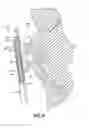 Fig. 05 - INSTRUMENTS FOR REMOVING DEBRIS FROM AN EYE