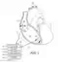 Fig. 02 - Dynamic patient-specific filtering of an activity signal within a beating heart