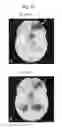 Fig. 14 - Immortalized stem cell, compositions, preparations and uses thereof