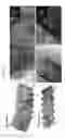 Fig. 28 - Al—Zn alloy comprising precipitates with improved strength and elongation and method of manufacturing the same