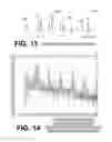 Fig. 11 - Filtering patient signal also for ventilation artifacts