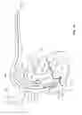 Fig. 02 - SYSTEM AND METHOD FOR POSITIONING AN ARTIFICIAL HEART VALVE AT THE POSITION OF A MALFUNCTIONING VALVE OF A HEART THROUGH A PERCUTANEOUS ROUTE