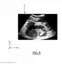 Fig. 04 - Ultrasound imaging apparatus and method for segmenting anatomical objects