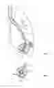 Fig. 02 - Cryosurgical instrument