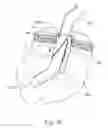 Fig. 06 - REMOVABLE MEDICAL RETRACTOR TIP