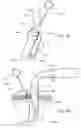Fig. 08 - REMOVABLE MEDICAL RETRACTOR TIP