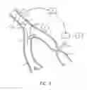 Fig. 07 - Noninvasive protection from emboli
