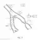 Fig. 08 - Noninvasive protection from emboli