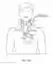 Fig. 22 - Noninvasive protection from emboli