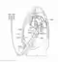 Fig. 01 - Diaphragm entry for posterior surgical access