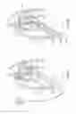 Fig. 04 - Diaphragm entry for posterior surgical access