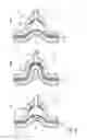 Fig. 05 - MICRODERMABRASION DEVICE