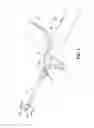 Fig. 02 - Surgical device with incorporated tissue extraction