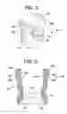 Fig. 05 - Bone anchor assemblies