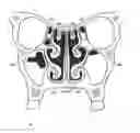 Fig. 01 - System & method for matching the results of a CT scan to a nasal-sinus surgery plan to treat migraine headaches