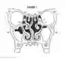 Fig. 02 - System & method for matching the results of a CT scan to a nasal-sinus surgery plan to treat migraine headaches