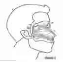 Fig. 04 - System & method for matching the results of a CT scan to a nasal-sinus surgery plan to treat migraine headaches