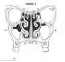 Fig. 05 - System & method for matching the results of a CT scan to a nasal-sinus surgery plan to treat migraine headaches