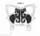 Fig. 06 - System & method for matching the results of a CT scan to a nasal-sinus surgery plan to treat migraine headaches