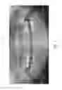 Fig. 02 - Therapeutic tooth bud ablation