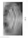 Fig. 03 - Therapeutic tooth bud ablation