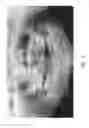 Fig. 04 - Therapeutic tooth bud ablation