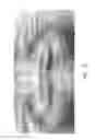 Fig. 14 - Therapeutic tooth bud ablation