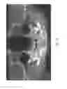 Fig. 15 - Therapeutic tooth bud ablation