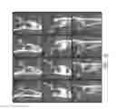 Fig. 16 - Therapeutic tooth bud ablation