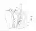 Fig. 17 - Therapeutic tooth bud ablation
