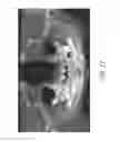 Fig. 23 - Therapeutic tooth bud ablation