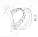 Fig. 30 - Therapeutic tooth bud ablation