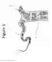 Fig. 02 - Device and method of performing cerclage sacrocervicopexy