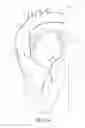 Fig. 02 - Adjustable endolumenal implant for reshaping the mitral valve annulus