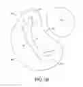 Fig. 03 - Adjustable endolumenal implant for reshaping the mitral valve annulus