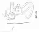 Fig. 07 - Adjustable endolumenal implant for reshaping the mitral valve annulus