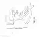 Fig. 08 - Adjustable endolumenal implant for reshaping the mitral valve annulus