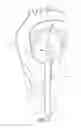 Fig. 09 - Adjustable endolumenal implant for reshaping the mitral valve annulus