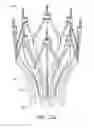 Fig. 40 - Adjustable endolumenal implant for reshaping the mitral valve annulus