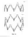 Fig. 50 - Adjustable endolumenal implant for reshaping the mitral valve annulus