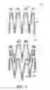 Fig. 52 - Adjustable endolumenal implant for reshaping the mitral valve annulus