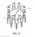 Fig. 53 - Adjustable endolumenal implant for reshaping the mitral valve annulus