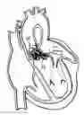 Fig. 01 - METHOD AND DESIGN FOR A MITRAL REGURGITATION TREATMENT DEVICE