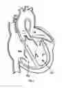 Fig. 02 - METHOD AND DESIGN FOR A MITRAL REGURGITATION TREATMENT DEVICE