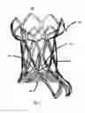Fig. 04 - METHOD AND DESIGN FOR A MITRAL REGURGITATION TREATMENT DEVICE