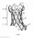 Fig. 05 - METHOD AND DESIGN FOR A MITRAL REGURGITATION TREATMENT DEVICE