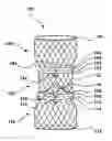 Fig. 01 - Modular valve prosthesis, delivery system, and method of delivering and deploying a modular valve prosthesis